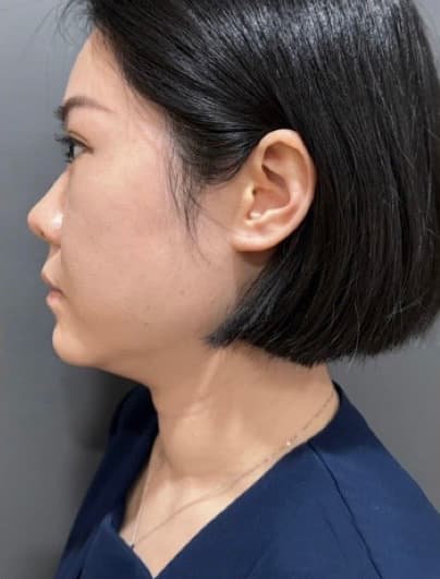 案例側面術前